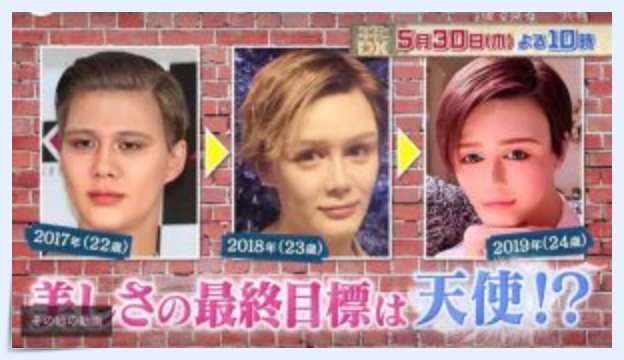 Mattは整形?【画像】すっぴんと昔の顔を時系列で比較してみた!